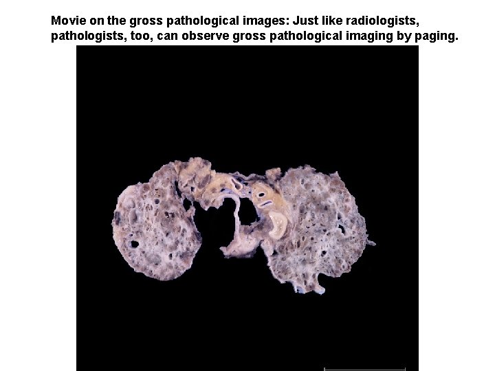 Movie on the gross pathological images: Just like radiologists, pathologists, too, can observe gross Movie on the gross pathological images: Just like radiologists, pathologists, too, can observe gross