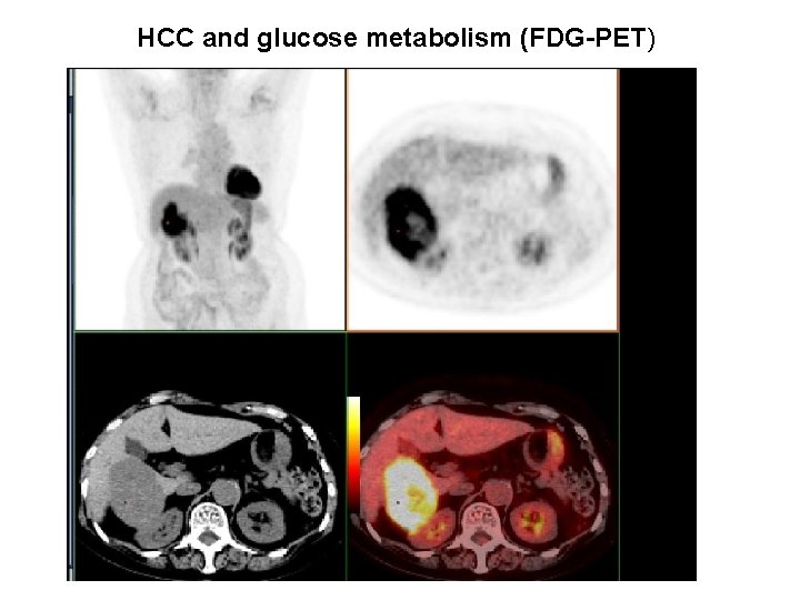 HCC and glucose metabolism (FDG-PET) HCC and glucose metabolism (FDG-PET)