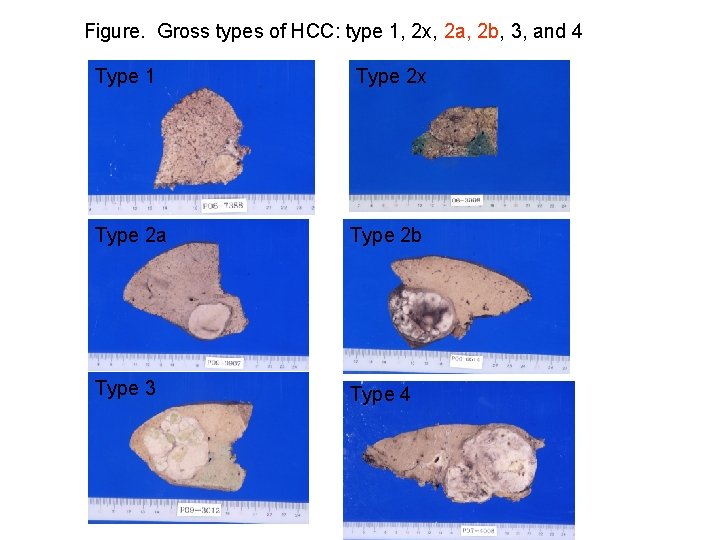 Figure. Gross types of HCC: type 1, 2 x, 2 a, 2 b, 3, Figure. Gross types of HCC: type 1, 2 x, 2 a, 2 b, 3,