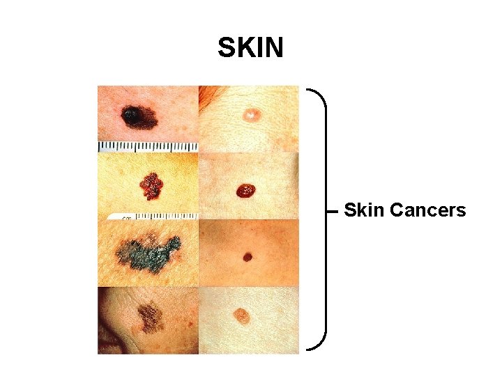 SKIN Skin Cancers 