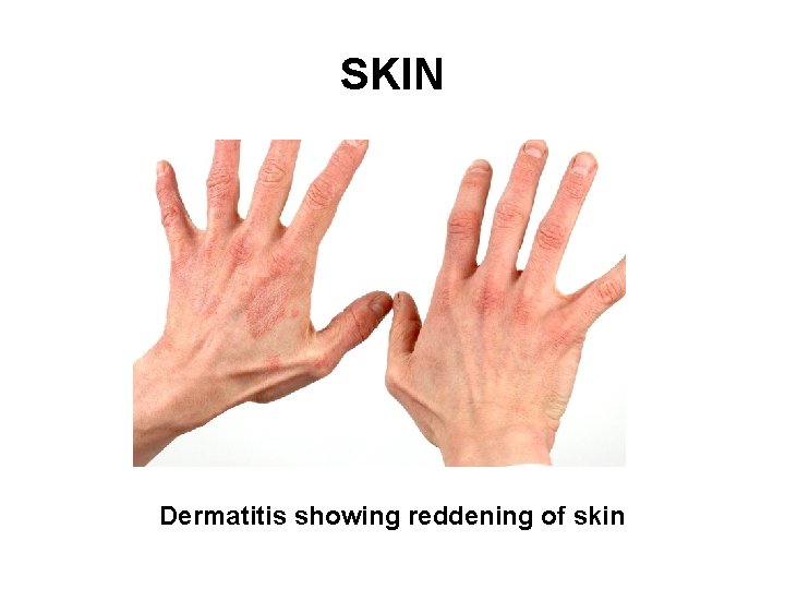 SKIN Dermatitis showing reddening of skin 