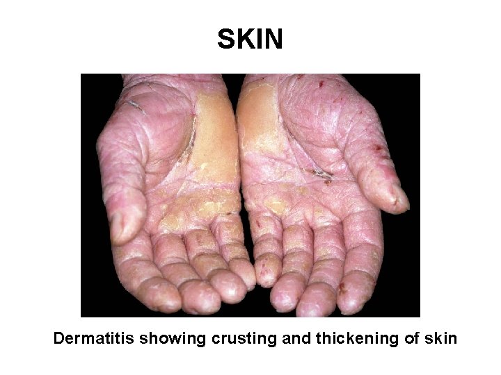 SKIN Dermatitis showing crusting and thickening of skin 