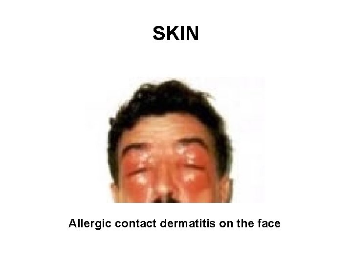 SKIN Allergic contact dermatitis on the face 