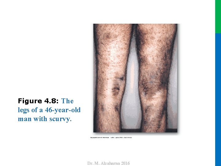 Figure 4. 8: The Dr. M. Alzaharna 2016 legs of a 46 -year-old man