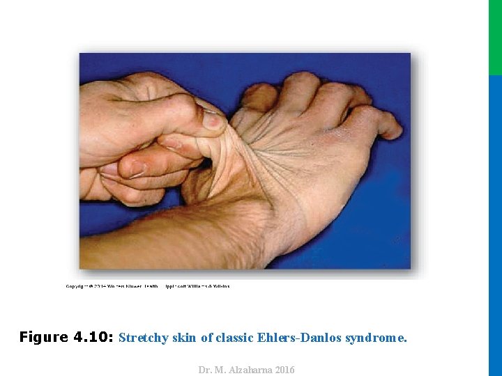 Dr. M. Alzaharna 2016 Figure 4. 10: Stretchy skin of classic Ehlers-Danlos syndrome. 