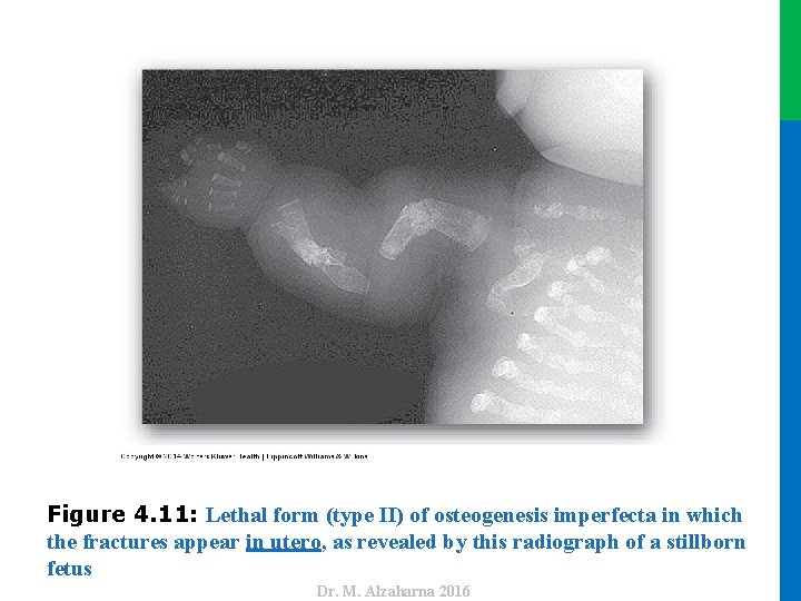 Dr. M. Alzaharna 2016 Figure 4. 11: Lethal form (type II) of osteogenesis imperfecta