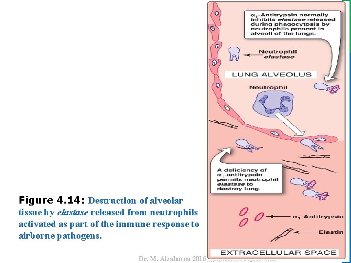 Dr. M. Alzaharna 2016 Figure 4. 14: Destruction of alveolar tissue by elastase released