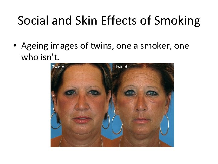 Social and Skin Effects of Smoking • Ageing images of twins, one a smoker,