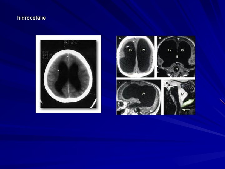 hidrocefalie 