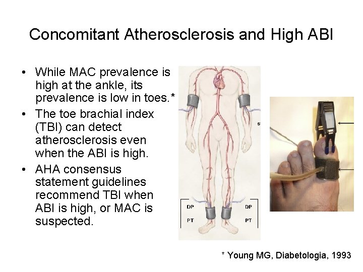 Concomitant Atherosclerosis and High ABI • While MAC prevalence is high at the ankle,