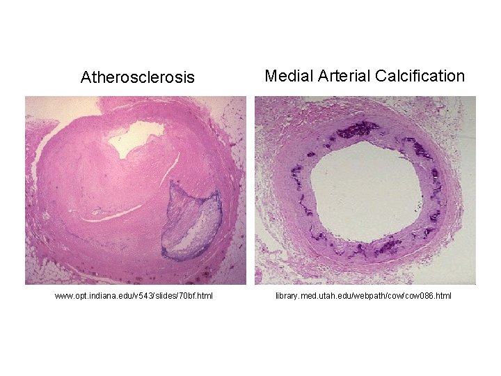Atherosclerosis www. opt. indiana. edu/v 543/slides/70 bf. html Medial Arterial Calcification library. med. utah.