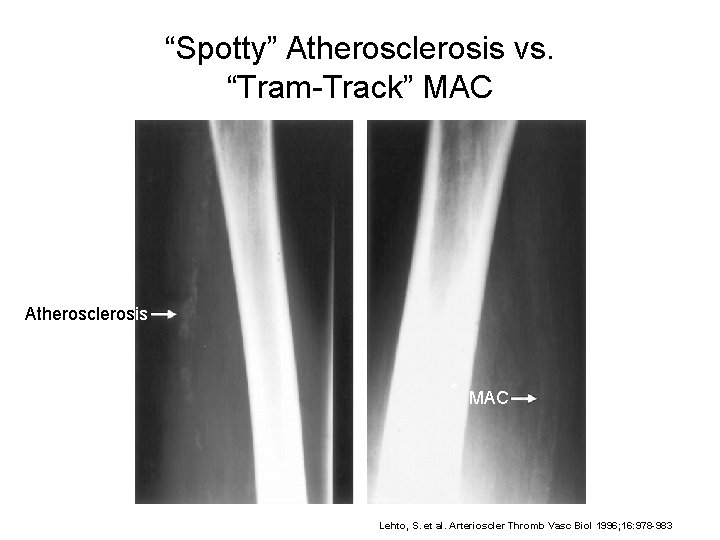 “Spotty” Atherosclerosis vs. “Tram-Track” MAC Atherosclerosis MAC Lehto, S. et al. Arterioscler Thromb Vasc