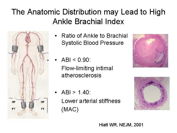 The Anatomic Distribution may Lead to High Ankle Brachial Index • Ratio of Ankle