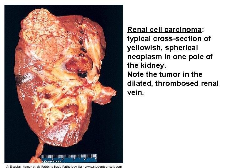 Renal cell carcinoma: typical cross-section of yellowish, spherical neoplasm in one pole of the