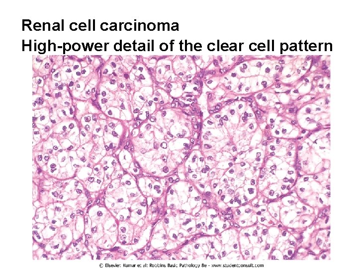 Renal cell carcinoma High-power detail of the clear cell pattern 