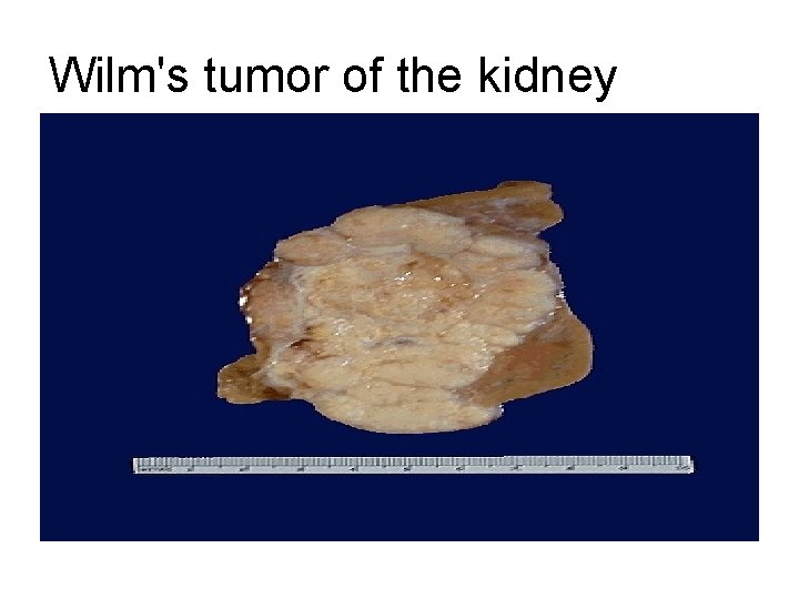 Wilm's tumor of the kidney 