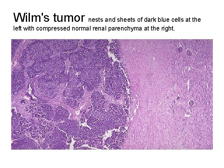 Wilm's tumor nests and sheets of dark blue cells at the left with compressed