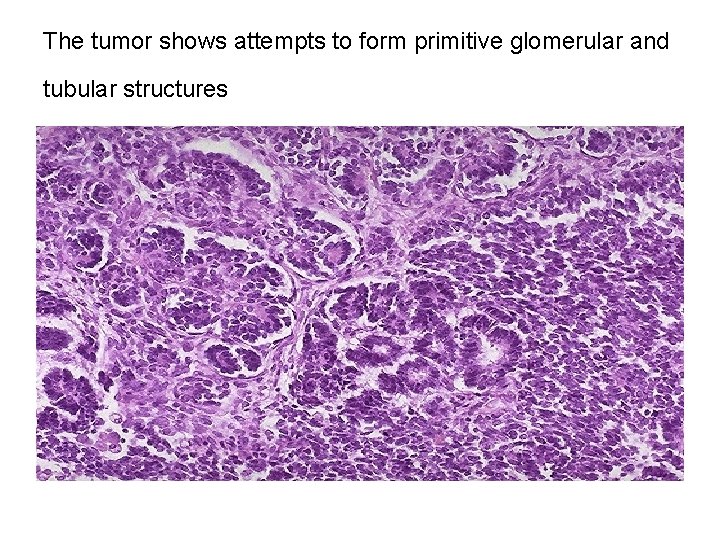 The tumor shows attempts to form primitive glomerular and tubular structures 