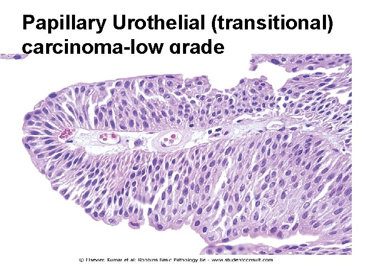 Papillary Urothelial (transitional) carcinoma-low grade 