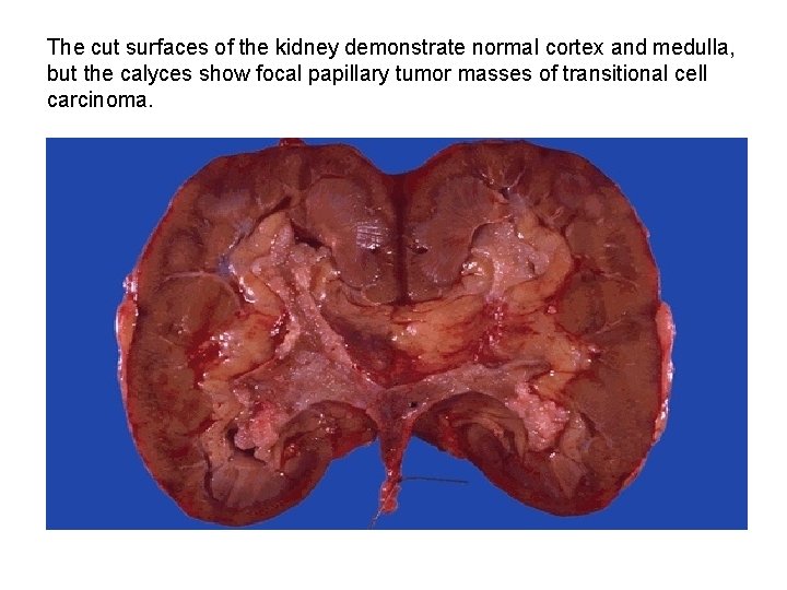 The cut surfaces of the kidney demonstrate normal cortex and medulla, but the calyces