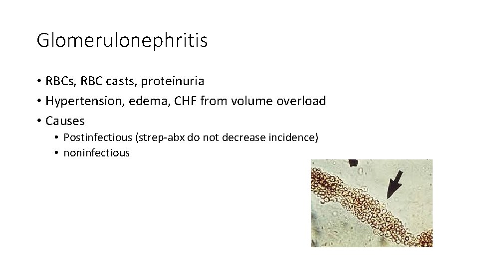 Glomerulonephritis • RBCs, RBC casts, proteinuria • Hypertension, edema, CHF from volume overload •