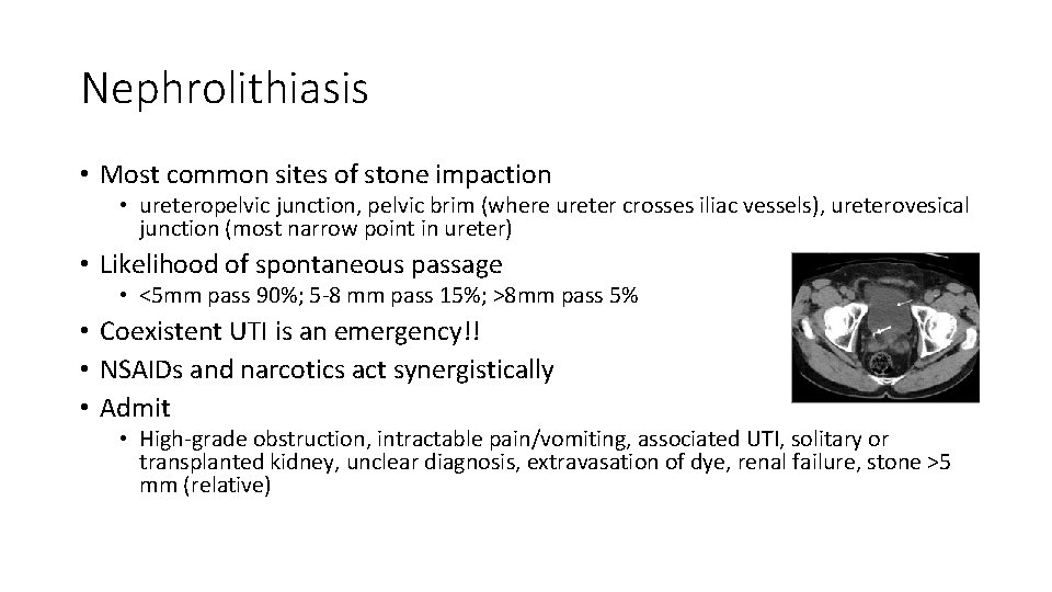 Nephrolithiasis • Most common sites of stone impaction • ureteropelvic junction, pelvic brim (where