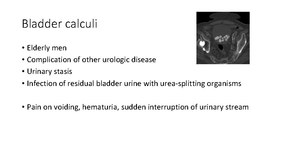 Bladder calculi • Elderly men • Complication of other urologic disease • Urinary stasis