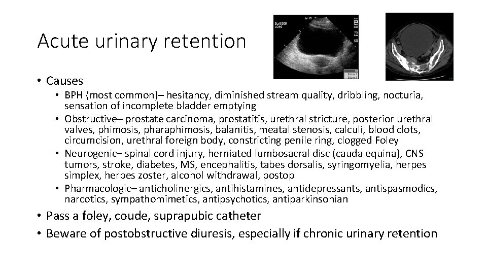 Acute urinary retention • Causes • BPH (most common)– hesitancy, diminished stream quality, dribbling,