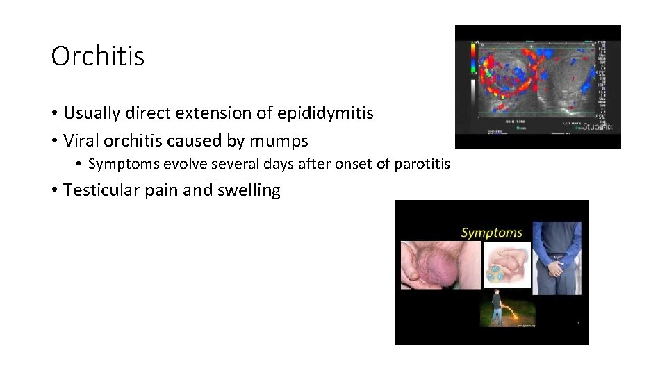 Orchitis • Usually direct extension of epididymitis • Viral orchitis caused by mumps •