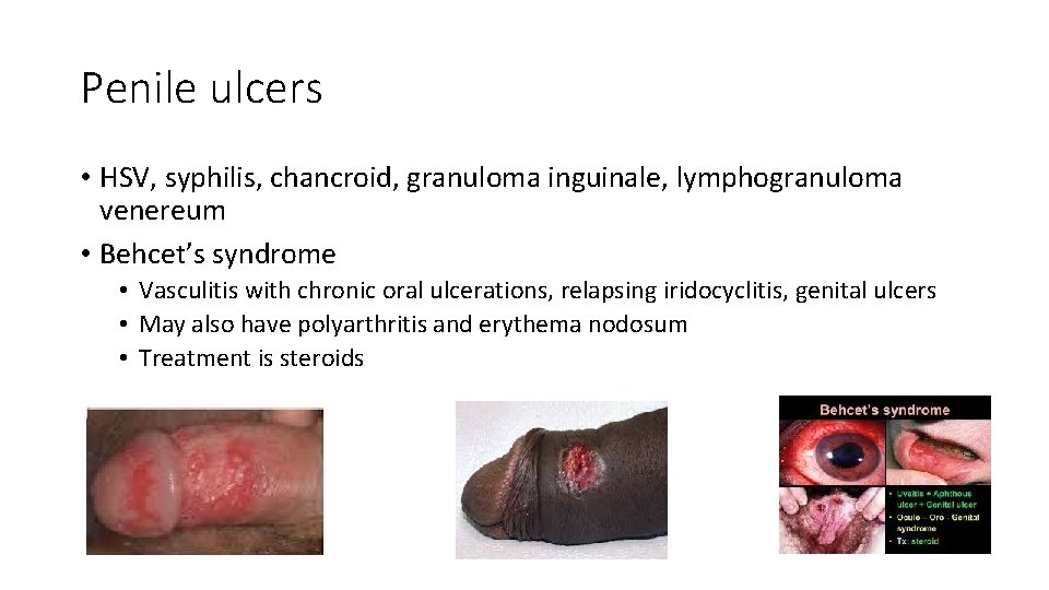 Penile ulcers • HSV, syphilis, chancroid, granuloma inguinale, lymphogranuloma venereum • Behcet’s syndrome •