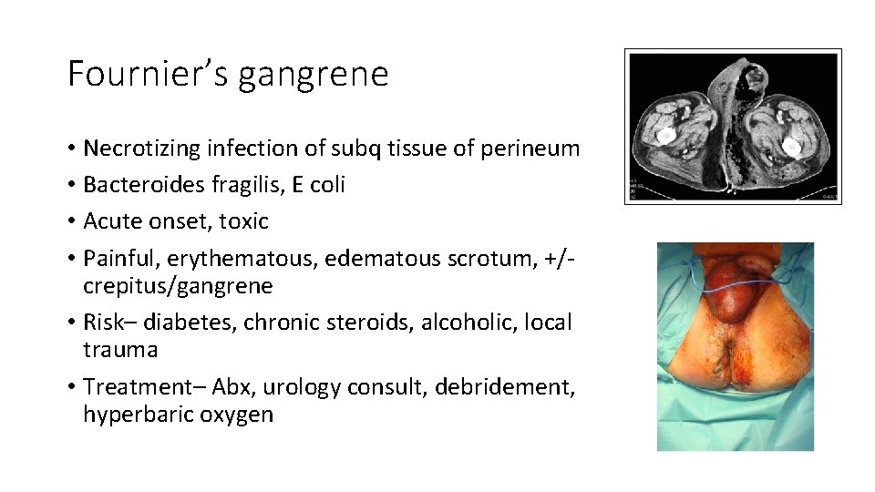 Fournier’s gangrene • Necrotizing infection of subq tissue of perineum • Bacteroides fragilis, E