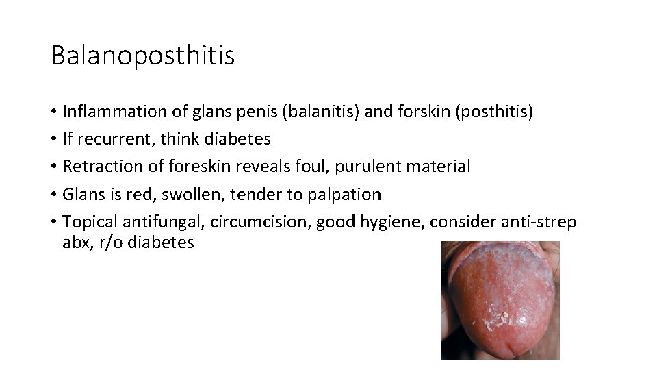 Balanoposthitis • Inflammation of glans penis (balanitis) and forskin (posthitis) • If recurrent, think