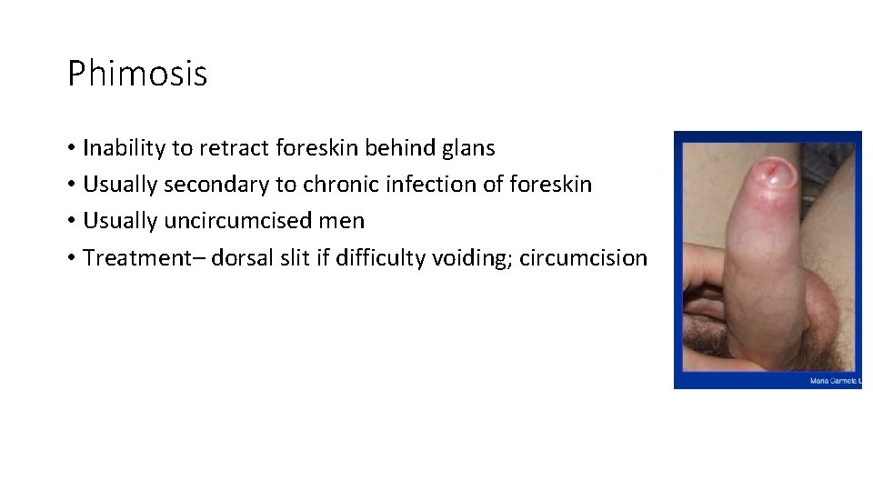 Phimosis • Inability to retract foreskin behind glans • Usually secondary to chronic infection