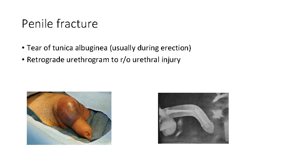 Penile fracture • Tear of tunica albuginea (usually during erection) • Retrograde urethrogram to
