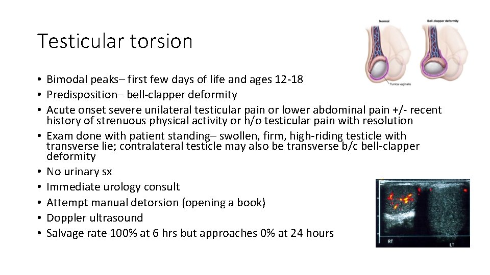 Testicular torsion • Bimodal peaks– first few days of life and ages 12 -18