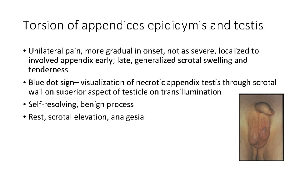 Torsion of appendices epididymis and testis • Unilateral pain, more gradual in onset, not