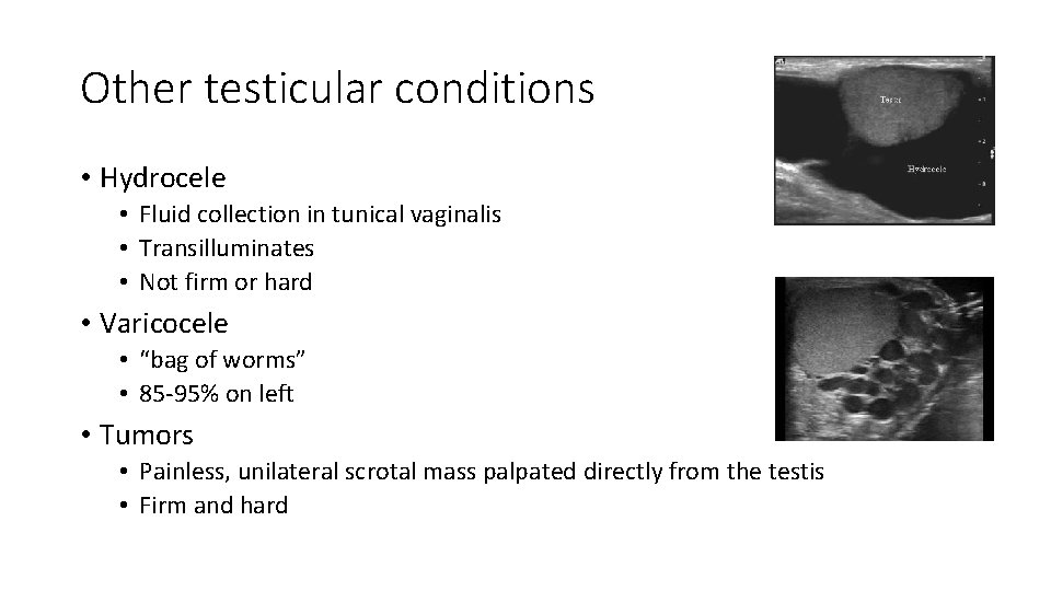 Other testicular conditions • Hydrocele • Fluid collection in tunical vaginalis • Transilluminates •