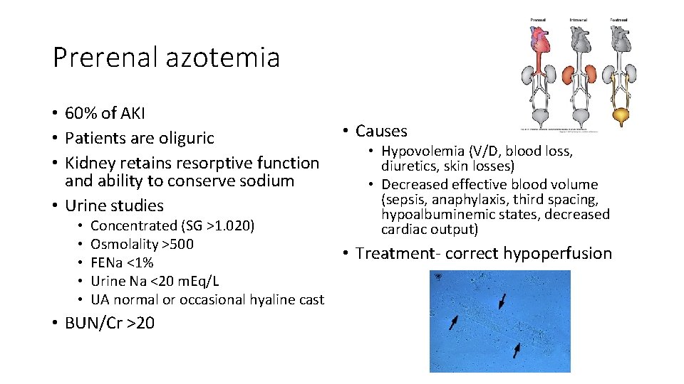Prerenal azotemia • 60% of AKI • Patients are oliguric • Kidney retains resorptive