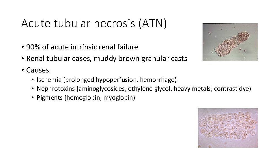 Acute tubular necrosis (ATN) • 90% of acute intrinsic renal failure • Renal tubular