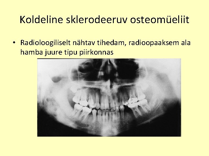 Koldeline sklerodeeruv osteomüeliit • Radioloogiliselt nähtav tihedam, radioopaaksem ala hamba juure tipu piirkonnas 