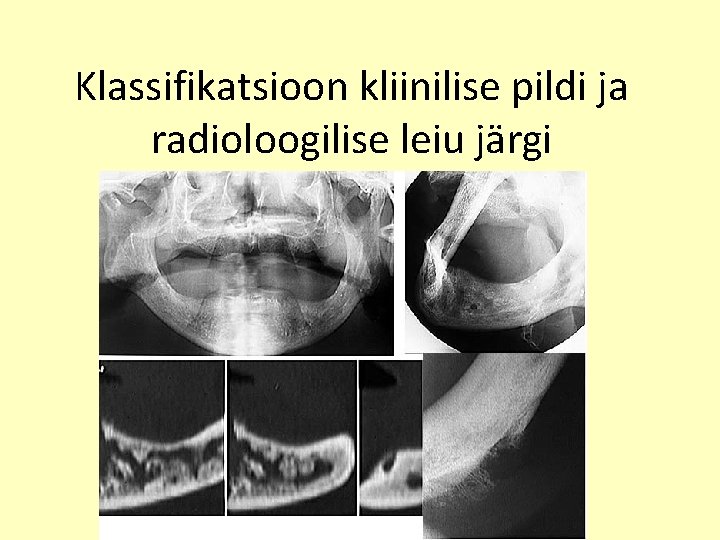 Klassifikatsioon kliinilise pildi ja radioloogilise leiu järgi 