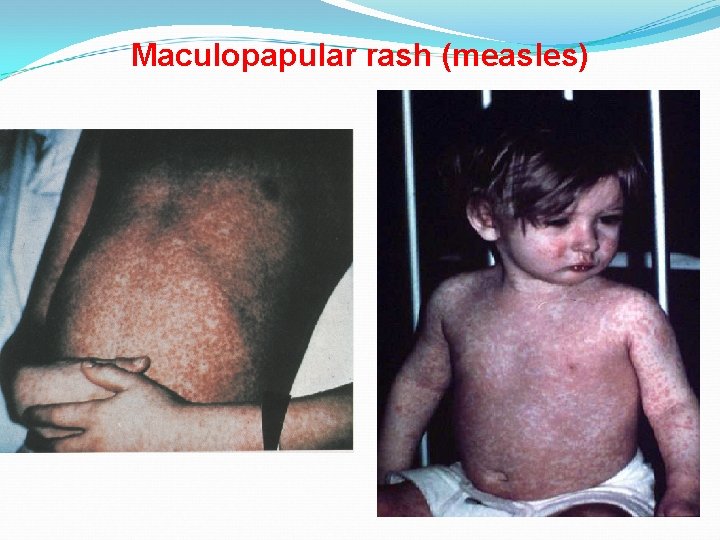 Maculopapular rash (measles) 