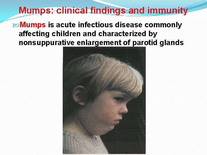 Mumps: clinical findings and immunity Mumps is acute infectious disease commonly affecting children and