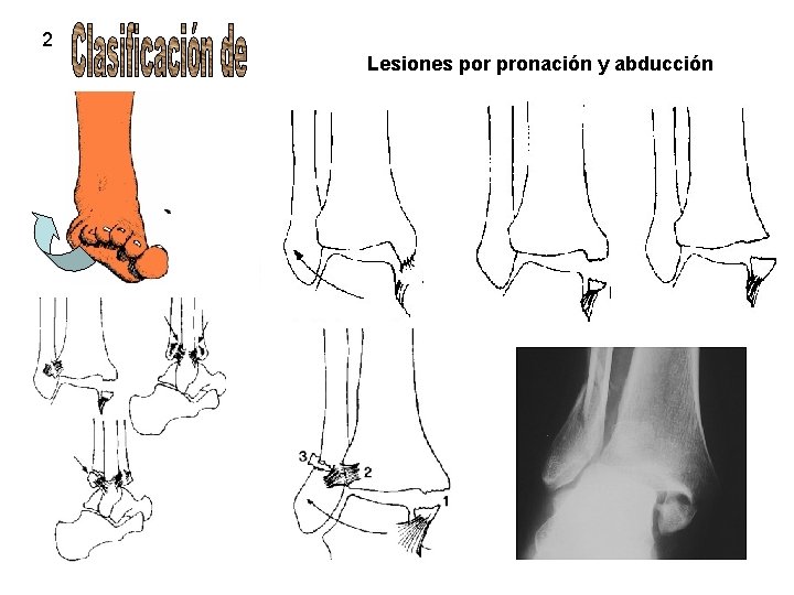 2 Lesiones por pronación y abducción 