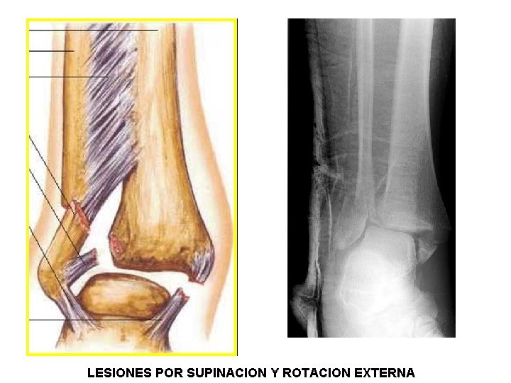 LESIONES POR SUPINACION Y ROTACION EXTERNA 