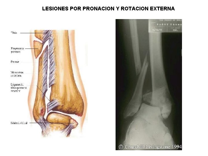 LESIONES POR PRONACION Y ROTACION EXTERNA 