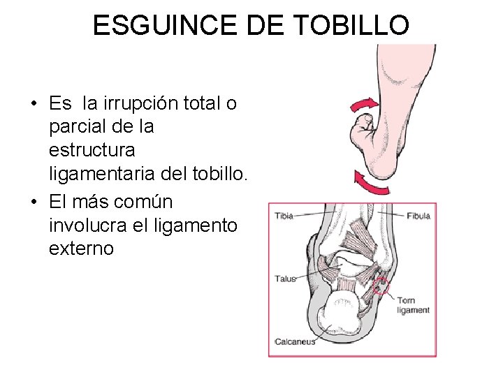 ESGUINCE DE TOBILLO • Es la irrupción total o parcial de la estructura ligamentaria