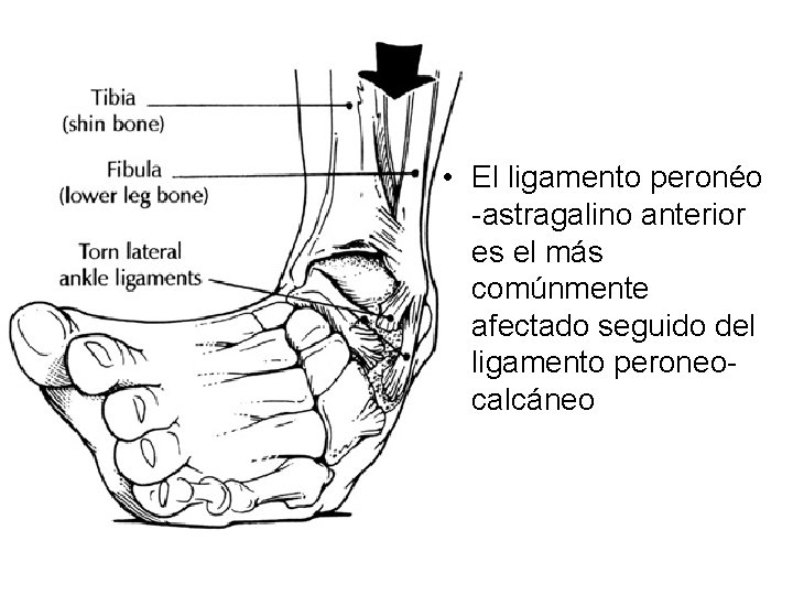  • El ligamento peronéo -astragalino anterior es el más comúnmente afectado seguido del