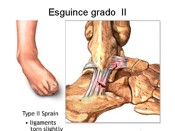 Esguince grado II 