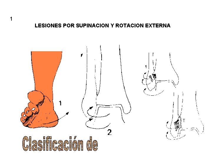 1 LESIONES POR SUPINACION Y ROTACION EXTERNA 